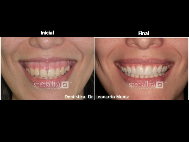 Excesso mandibular - Deficiência maxilar - Classe III - Dra