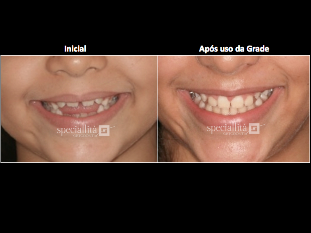 Modifica o Obtida No Sorriso vista Aproximada 